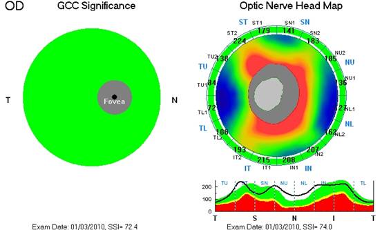 tomografia optica coherente OCT